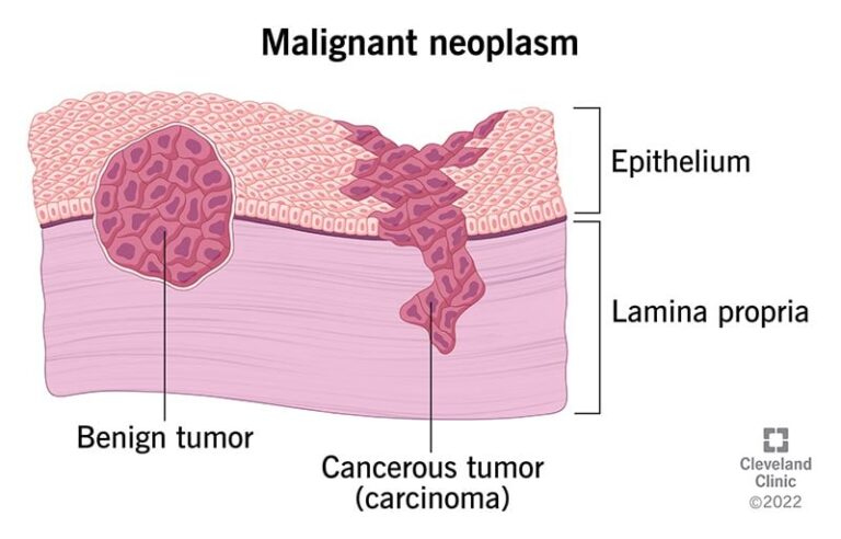 22319-malignant-neoplasm